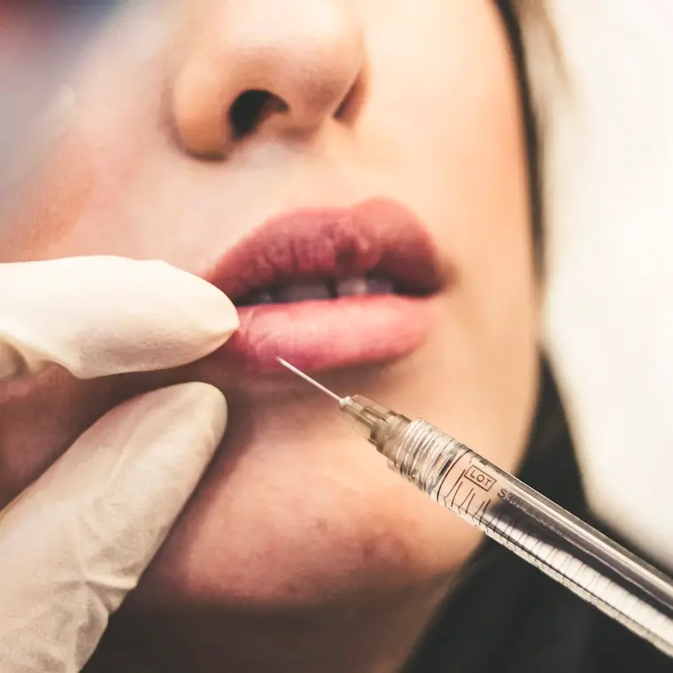 Russian Lips Lippenbehandlung bei MYSSAK Aesthetics in Berlin — Eindruck 8